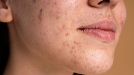 Bã nhờn dư thừa có thể khiến lỗ chân lông kém thông thoáng và dễ hình thành mụn