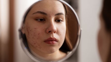 Bã nhờn kết hợp với tế bào sừng tích tụ có thể làm nang lông vùng mũi bị bít tắc và tạo điều kiện hình thành mụn.