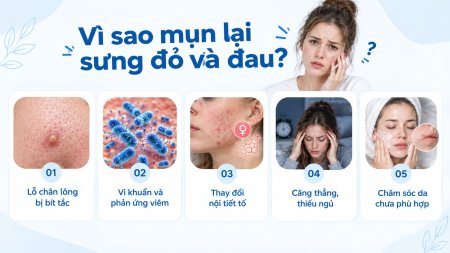 Mụn sưng đỏ và đau thường liên quan đến bít tắc lỗ chân lông và phản ứng viêm trên da