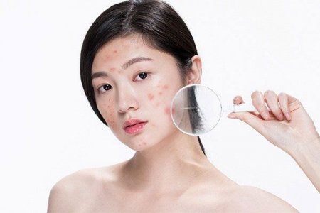 cách trị mụn tại nhà hiệu quả sau 1 đêm