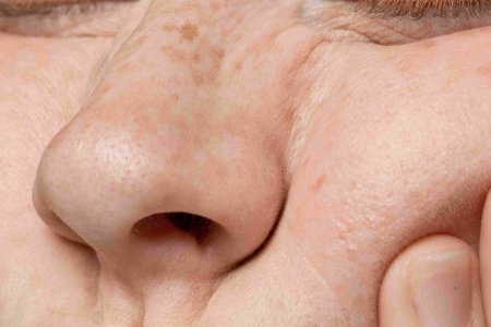 Theo thời gian, độ đàn hồi da suy giảm có thể khiến lỗ chân lông trông rõ hơn. 