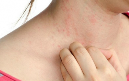 dễ bị phát ban và nổi mụn