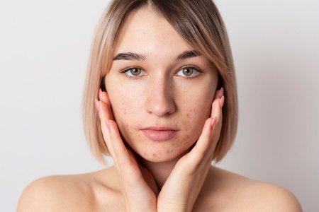 Biện pháp ngăn ngừa thâm mụn ngay khi nổi mụn
