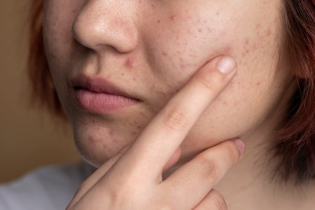 Triệu chứng nhận biết mụn cứng dưới da
