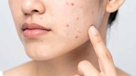 Hàng rào bảo vệ da suy yếu làm tăng nguy cơ kích ứng 