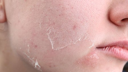 Da thiếu ẩm có thể trở nên khô ráp, bong tróc hoặc căng tức và dễ bị tác động bởi các yếu tố từ môi trường