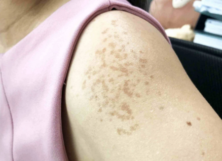 Nám ở tay Nguyên nhân và cách điều trị