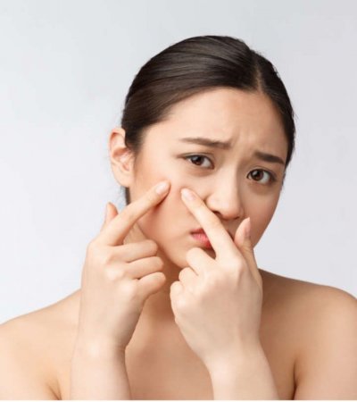 nguyên nhân gây mụn và cách phòng ngừa