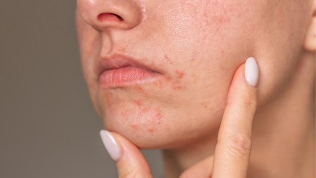 Nếu da xuất hiện dấu hiệu kích ứng sau khi thoa kem dưỡng, nên làm sạch da nhẹ nhàng và theo dõi phản ứng