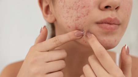 Nặn sai thời điểm có thể làm tăng nguy cơ thâm sẹo
