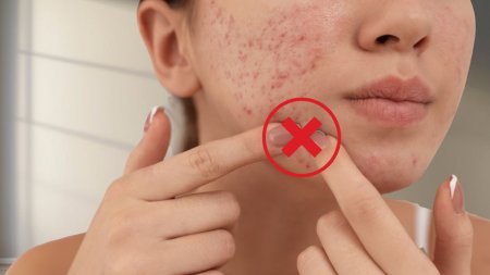 Hạn chế nặn hoặc cạy mụn giúp giảm tổn thương và nguy cơ để lại dấu sau mụn
