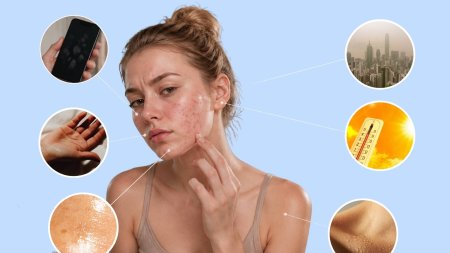 Mồ hôi, nhiệt độ, độ ẩm, ma sát và cặn sản phẩm có thể góp phần khiến tình trạng mụn khó kiểm soát