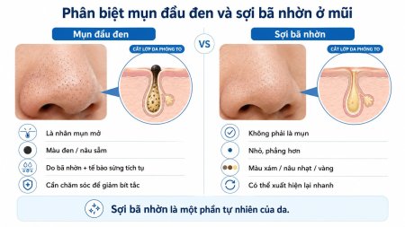Mụn đầu đen là nhân mụn mở do bã nhờn và tế bào sừng tích tụ, trong khi sợi bã nhờn là cấu trúc tự nhiên giúp dẫn bã nhờn lên bề mặt da.