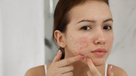 Mụn ở cằm thường liên quan đến vấn đề nội tiết 