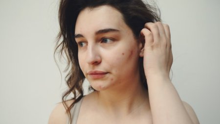 Mụn có thể tái phát khi bã nhờn, bít tắc và viêm chưa được kiểm soát ổn định