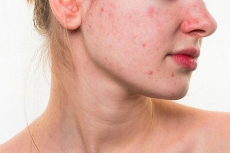 Mụn tái phát quanh chu kỳ kinh nguyệt có thể liên quan đến sự thay đổi nội tiết tố và hoạt động của tuyến bã nhờn.