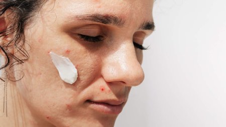 Da dầu, da nhạy cảm hay da treatment đều cần kem dưỡng trị mụn phù hợp riêng 