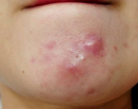 Mụn cứng dưới da là gì