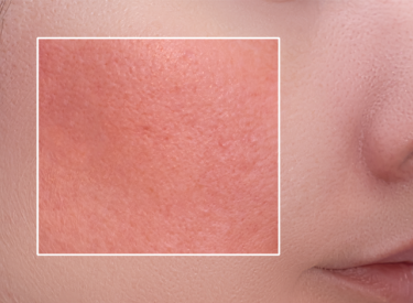 bệnh dị ứng miễn dịch