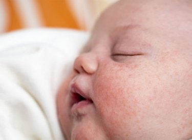 Biểu hiện của Chàm thể tạng như thế nào?