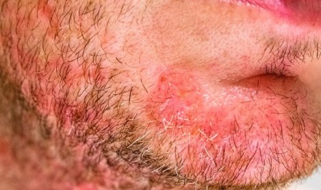 hình ảnh bị viêm da tiết bã nhờn